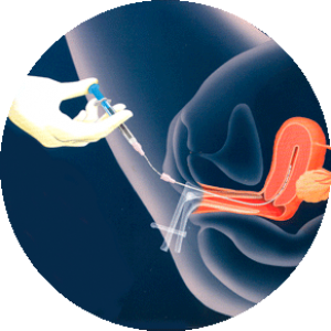 Inseminacion-Artificial Inseminacion-Artificial