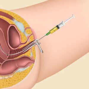 Inseminacion-intrauterina-600x600